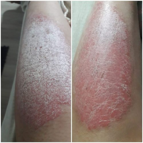 fotosantesydespuescerarbol